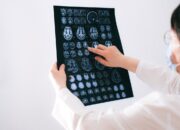 Stroke Masih Jadi Pembunuh Nomor Satu di Indonesia, Banyak Gejalanya Tak Disadari
